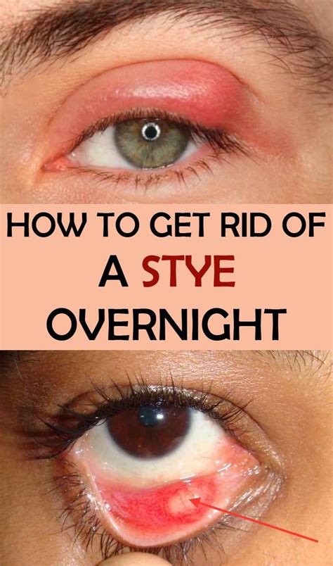 how to cure stye in upper eyelid