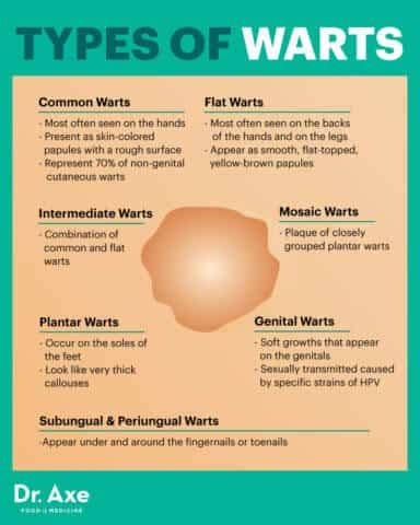 how to deal with hpv warts