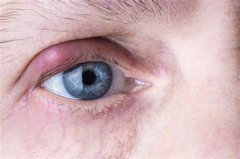 how to deal with stye on eyelid