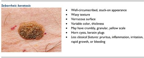 how to describe seborrheic keratosis derm