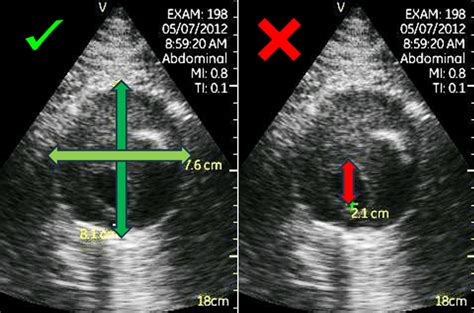 how to detect aaa