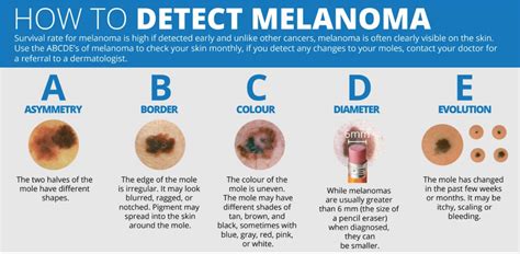 how to detect melanoma