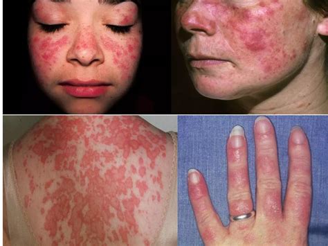 how to detect systemic lupus erythematosus