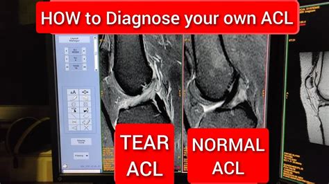 how to detect torn acl