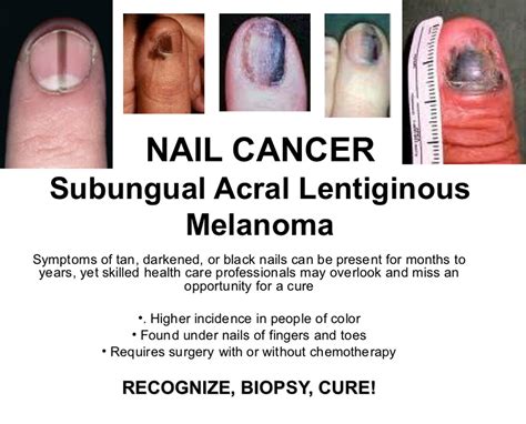 how to diagnose melanoma under toenail