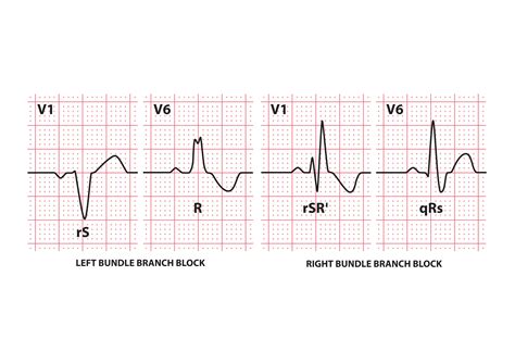 how to differentiate between right and left bundle branch block