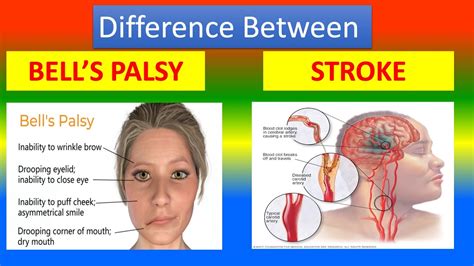 how to distinguish bell's palsy from stroke