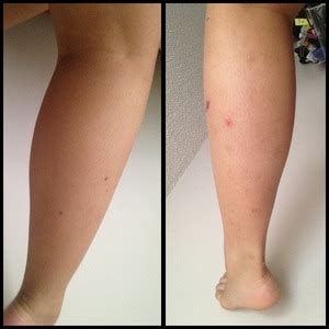 how to fade bug bite scars