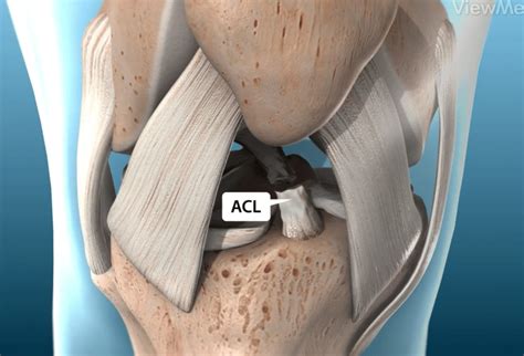 how to fix a acl