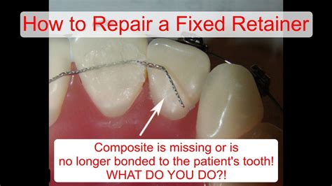 How To Fix A Broken Bottom Retainer