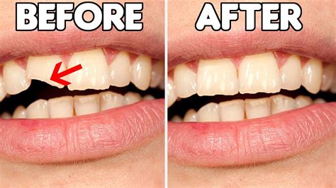how to fix a cracked tooth in the front