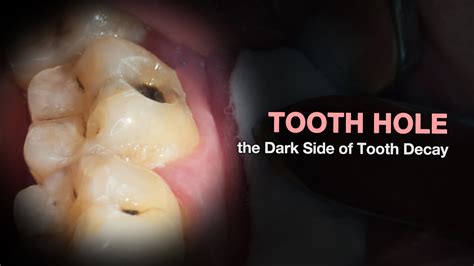 how to fix a small hole in your tooth
