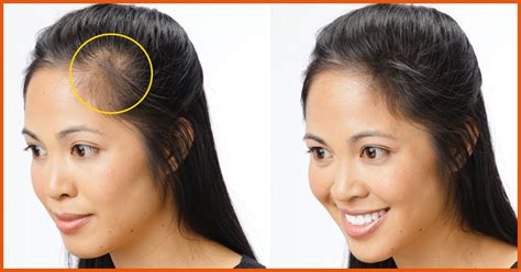 How To Fix Bald Spots In Women s Hair Naturally