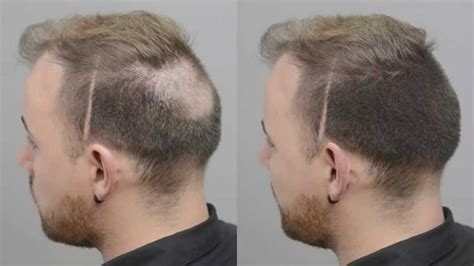 How To Fix Balding On Top Of Head