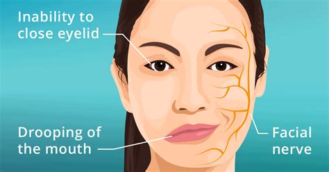 how to fix bell's palsy