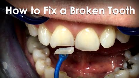 how to fix broken front tooth at home