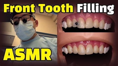 how to fix cavity in teeth