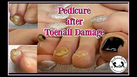 How To Fix Damaged Toenails