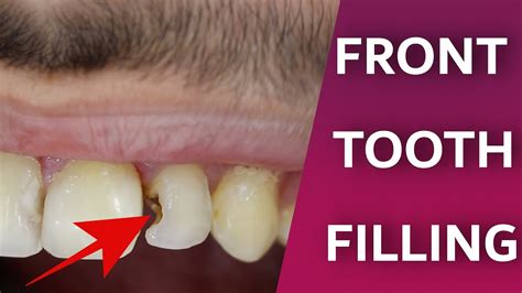 how to fix decay in tooth