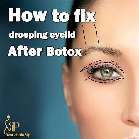  79 Ideas How To Fix Droopy Eyes After Botox For Short Hair