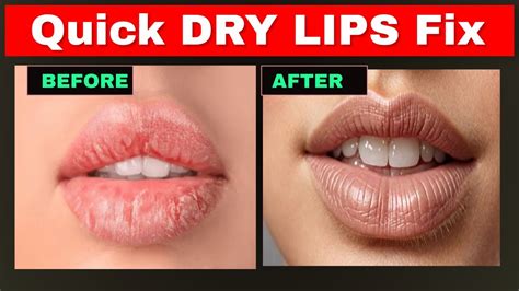 How To Fix Dry Lips