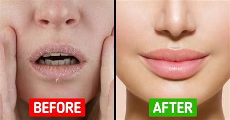 How To Fix Extremely Dry Lips