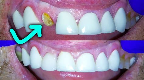 how to fix fractured front tooth