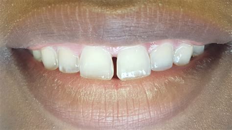 how to fix gap between two front teeth