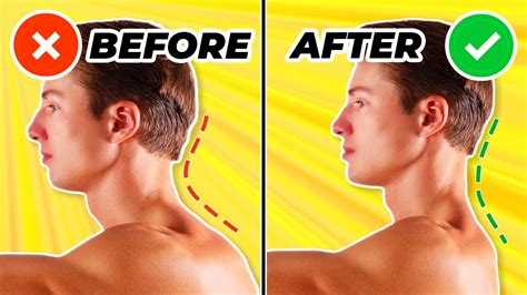 how to fix neck posture exercises
