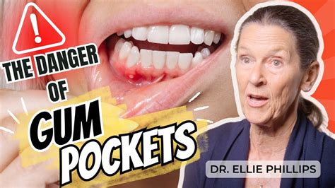 how to fix pockets in gums