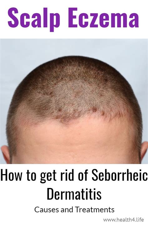 how to fix seborrheic dermatitis