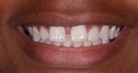 how to fix space between front teeth