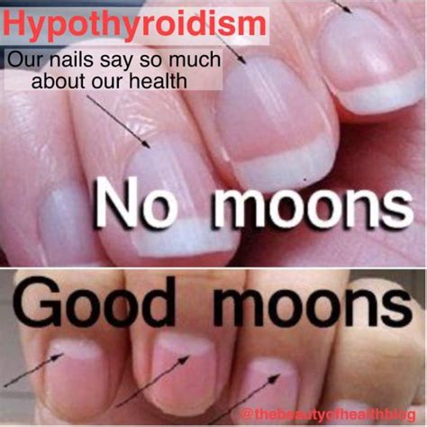 how to fix thyroid nails
