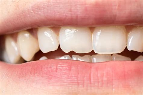 how to fix tiny chip in tooth
