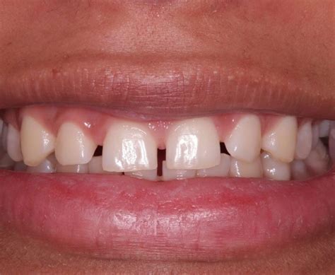 how to fix triangular spaces between teeth