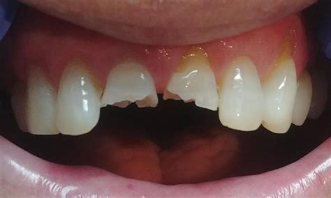 how to fix two front broken teeth