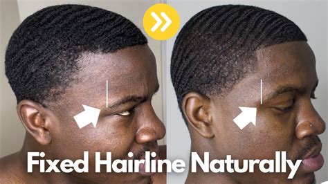 How To Fix Your Hairline Black Female  A Comprehensive Guide