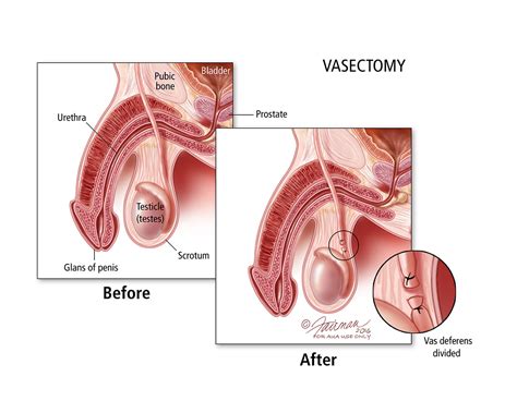 A Vasectomy for Life: How to Get a Vasectomy Safely and Effectively