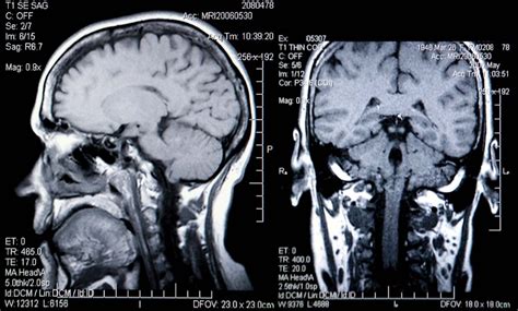 How To Get Brain Imaging