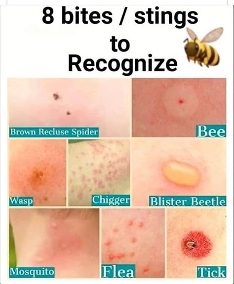 How To Get Mosquito Bites To Stop Itching Reddit