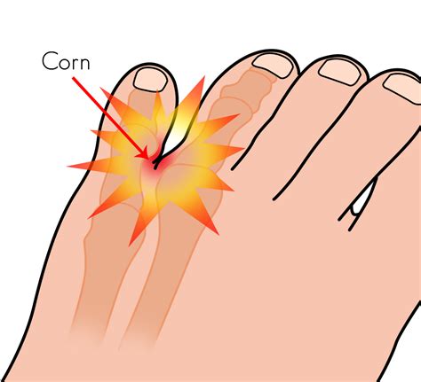 How To Get Rid Of A Corn In Between My Toes