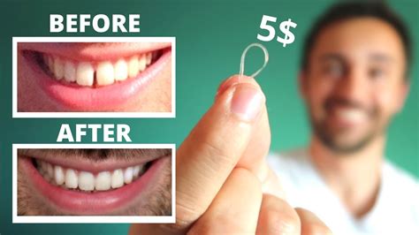 how to get rid of a gap in your teeth naturally