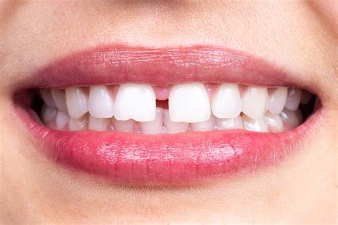 how to get rid of a gap in your two front teeth