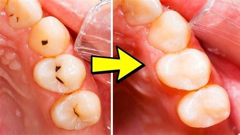 how to get rid of a hole in your tooth at home
