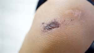How To Get Rid Of A Scrape Fast