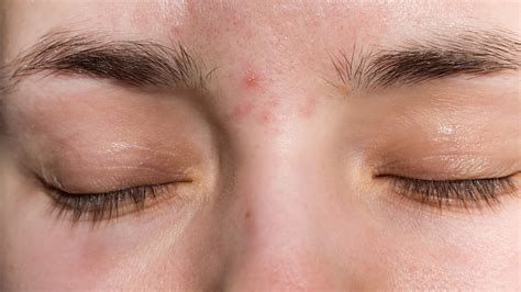 How to Get Rid of Acne Between Eyebrows: Natural Remedies and Preventive Measures