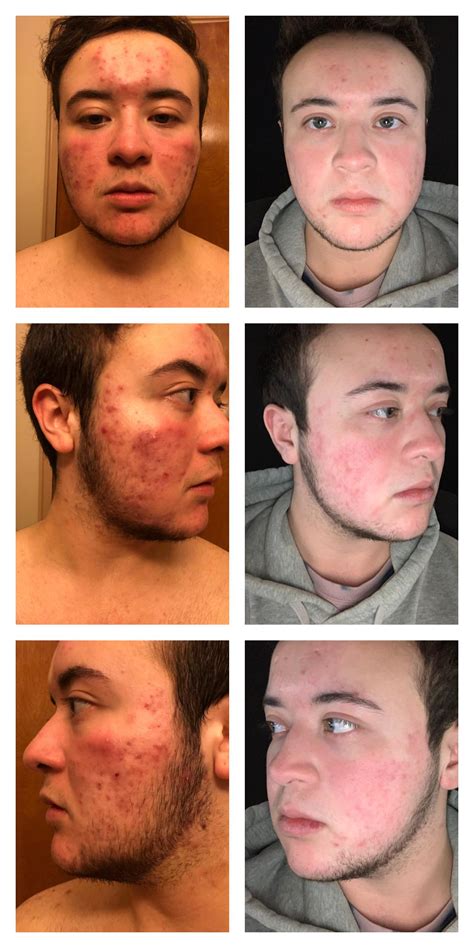 How to Get Rid of Acne from Testosterone: 15 Home Remedies and More
