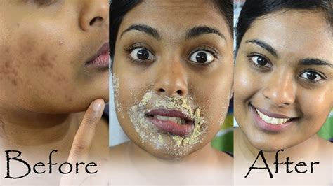 How To Get Rid Of Acne Marks Hyperpigmentation