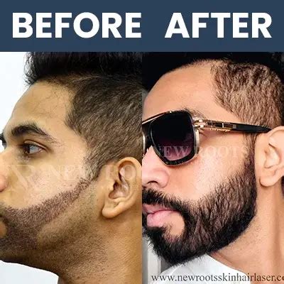 How To Get Rid Of Bald Patches In Your Beard