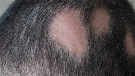 How To Get Rid Of Bald Patches On Scalp   Tips And Hair Care Guide